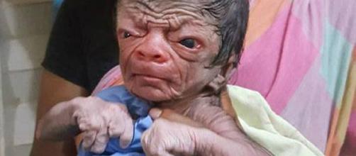Menino de Bangladesh que nasceu com progeria.