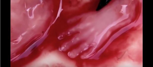 Tak wygląda proces aborcji, sami oceńcie czy to człowiek czy nie. Tak wygląda proces aborcji, sami oceńcie czy to człowiek czy nie.