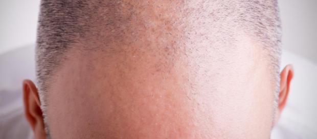 Calvizie: scoperti principi attivi che fanno ricrescere i capelli ... - panorama.it Calvizie: scoperti principi attivi che fanno ricrescere i capelli ... - panorama.it
