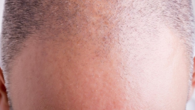 Calvizie: scoperti principi attivi che fanno ricrescere i capelli ... - panorama.it