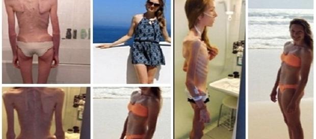 Hannah Koestler tinha uma doença muito cruel Hannah Koestler tinha uma doença muito cruel