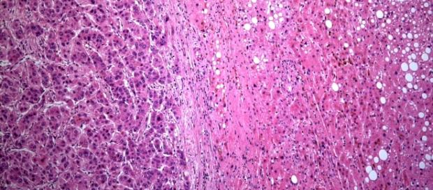 Lebergewebe mit fortgeschrittener Steatohepatitis (Leberkrebs) Lebergewebe mit fortgeschrittener Steatohepatitis (Leberkrebs)