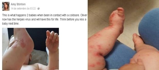 Mãe faz alerta sobre herpes no Facebook Mãe faz alerta sobre herpes no Facebook
