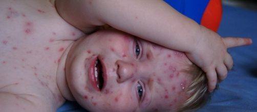 Chickenpox Becoming Rarer Thanks to Two-Dose Vaccine – Jilard ... - jilard.com
