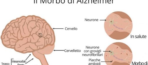 Forse è stata scoperta l'origine del morbo di Alzheimer