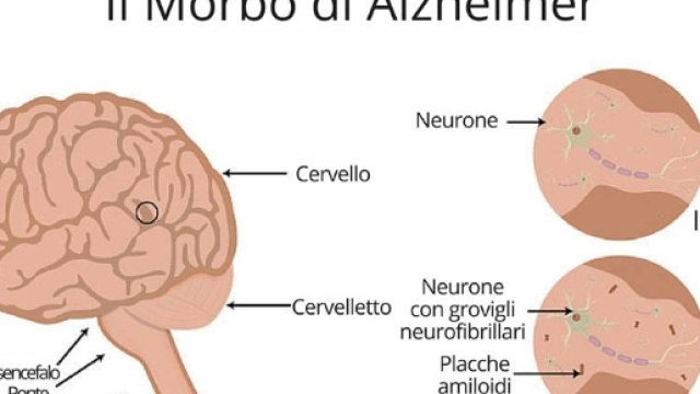 Forse è stata scoperta l'origine del morbo di Alzheimer