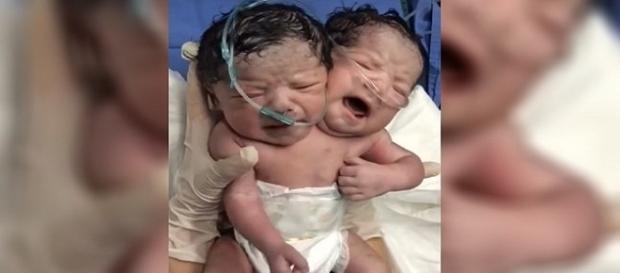 Bebê nasce com duas cabeças em uma cidade do México. Bebê nasce com duas cabeças em uma cidade do México.
