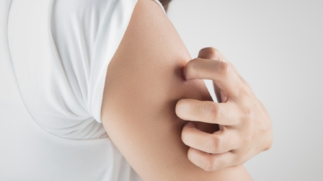 Allergia al nichel sistemica (SNAS), la dieta a basso contenuto di nichel migliora i sintomi