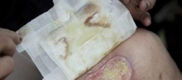 Krokodil, é a droga mais letal que existe no mundo Krokodil, é a droga mais letal que existe no mundo
