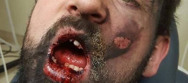 Homem fica seriamente ferido com explosão de cigarro. Homem fica seriamente ferido com explosão de cigarro.