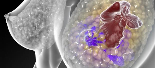 New 'mutation-tracking' blood test could predict breast cancer ... - medicalxpress.com New 'mutation-tracking' blood test could predict breast cancer ... - medicalxpress.com