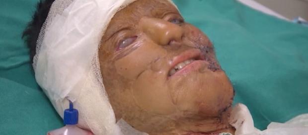 Vítima de ataque com ácido é exemplo de superação Vítima de ataque com ácido é exemplo de superação