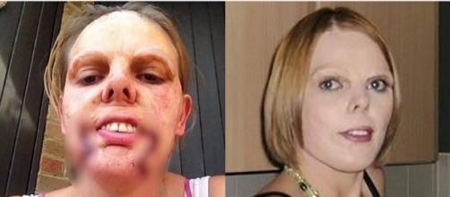 Mulher fica com rosto deformado após erro médico em operação.