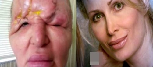 Botox deixou o rosto da mulher completamente deformado.