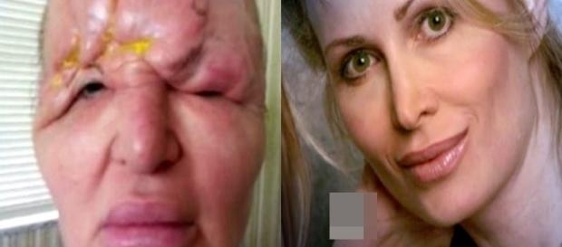 Botox deixou o rosto da mulher completamente deformado. Botox deixou o rosto da mulher completamente deformado.