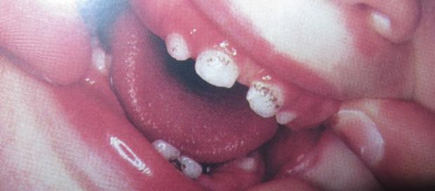 Dentes de leite com manchas escuras Dentes de leite com manchas escuras