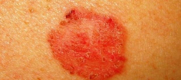 Manchas vermelhas pelo corpo podem indicar algo grave Manchas vermelhas pelo corpo podem indicar algo grave