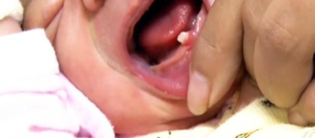 G1 - Em caso raro, bebê nasce com dente formado em cidade de Mato ... - globo.com G1 - Em caso raro, bebê nasce com dente formado em cidade de Mato ... - globo.com
