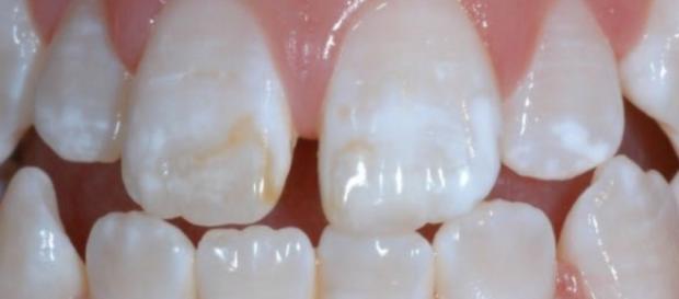 Manchas de fluorose em dentição permanente de criança. (https://goo.gl/images/CyJkwL) Manchas de fluorose em dentição permanente de criança. (https://goo.gl/images/CyJkwL)