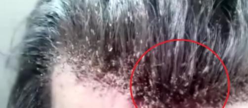 Vídeo chocante mostra homem infestado de piolhos