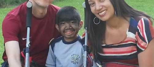 Niño venezolano con síndorme de Hombre Lobo