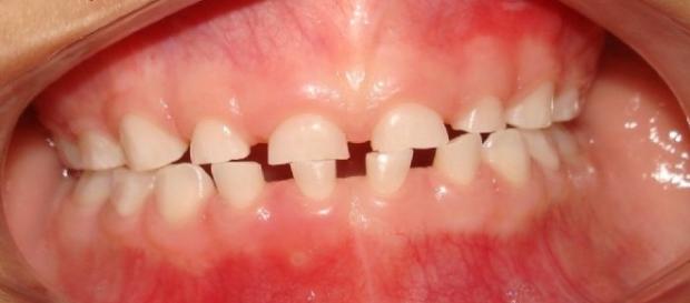 Efeitos do bruxismo na dentição infantil (https://goo.gl/images/Ja07nl) Efeitos do bruxismo na dentição infantil (https://goo.gl/images/Ja07nl)