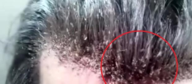 Vídeo chocante mostra homem infestado de piolhos Vídeo chocante mostra homem infestado de piolhos
