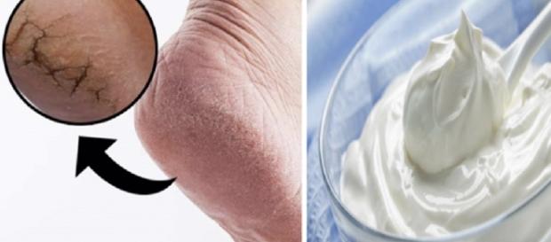 Dicas caseiras para melhoras as rachaduras dos pés - Imagem/Google Dicas caseiras para melhoras as rachaduras dos pés - Imagem/Google