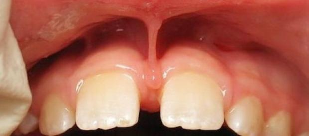 Freio labial com baixa inserção na dentição mista (https://goo.gl/images/x6RbQU) Freio labial com baixa inserção na dentição mista (https://goo.gl/images/x6RbQU)