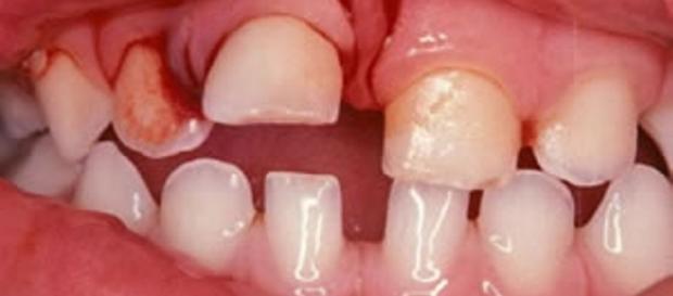 Traumatismo dental na dentição decídua - luxação intrusiva. (https://goo.gl/images/0Za4Ft) Traumatismo dental na dentição decídua - luxação intrusiva. (https://goo.gl/images/0Za4Ft)