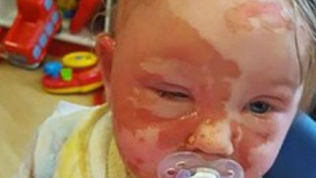 UK, afferra tazza di t&egrave; caldo e resta ustionata