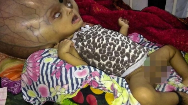 India, il bimbo con la testa pi&ugrave; grande del mondo