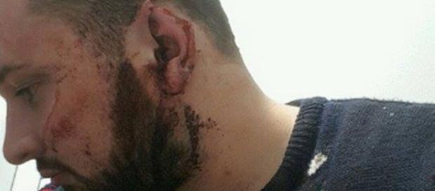 Irlanda, 23enne aggredito e preso a morsi: ha perso una parte di orecchio Irlanda, 23enne aggredito e preso a morsi: ha perso una parte di orecchio
