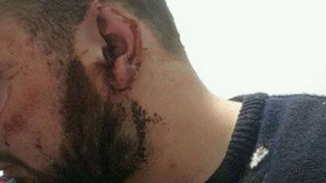 Irlanda, 23enne aggredito e preso a morsi: ha perso una parte di orecchio