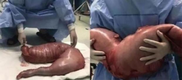 Parte do intestino de paciente é retirada Parte do intestino de paciente é retirada