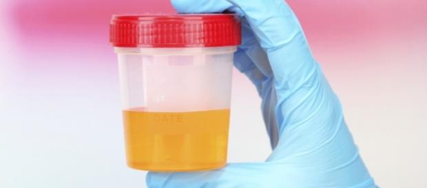 Infecção de urina pode causar problema sério para saúde Infecção de urina pode causar problema sério para saúde