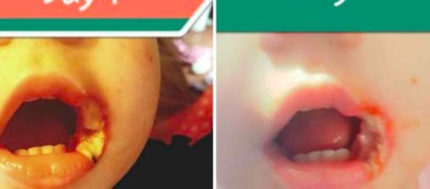 Bebê de um ano e meio queima a boca com um fio de carregador Bebê de um ano e meio queima a boca com um fio de carregador