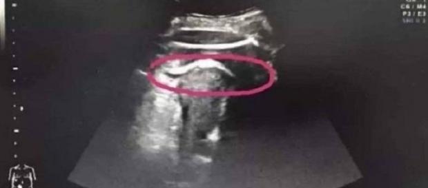 Imagens do ultrassom mostram perna do feto para fora da parede uterina (Foto: Reprodução Hospital) Imagens do ultrassom mostram perna do feto para fora da parede uterina (Foto: Reprodução Hospital)
