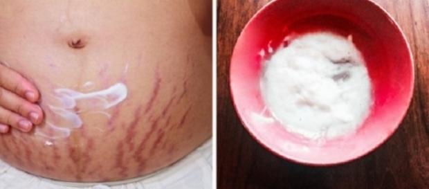 Cure estrias usando babosa e óleo de amêndoa Cure estrias usando babosa e óleo de amêndoa