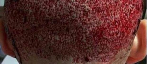 Área doadora após transplante capilar em clínica clandestina Área doadora após transplante capilar em clínica clandestina