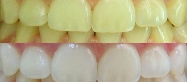 Como clarear os dentes sem sair de casa Como clarear os dentes sem sair de casa