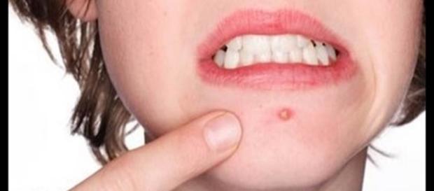 O aparecimento da acne pode contribuir para a insegurança dos adolescentes O aparecimento da acne pode contribuir para a insegurança dos adolescentes