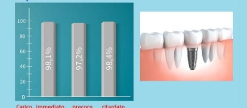 Le moderne tecniche di implantologia sono molto efficace, quelle a carico precoce preservano meglio il livello di osso peri-impianto.