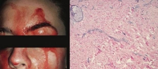 Análise do tecido cutâneo da paciente (à direita) mostra que ela possui uma pele normal, algo que intriga os médicos Análise do tecido cutâneo da paciente (à direita) mostra que ela possui uma pele normal, algo que intriga os médicos