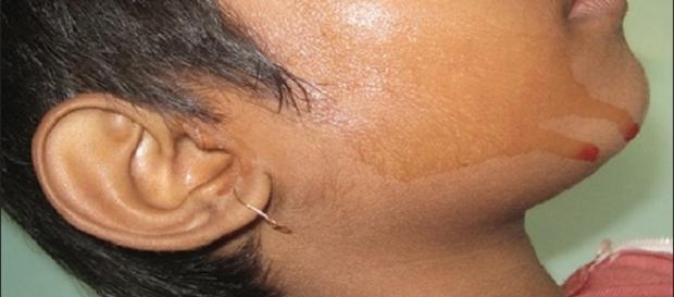Hematohidrosis | By Saugato Biswas, Trupti Surana, Abhishek De (Image via Falguni Nag/Wikimedia Commons) Hematohidrosis | By Saugato Biswas, Trupti Surana, Abhishek De (Image via Falguni Nag/Wikimedia Commons)