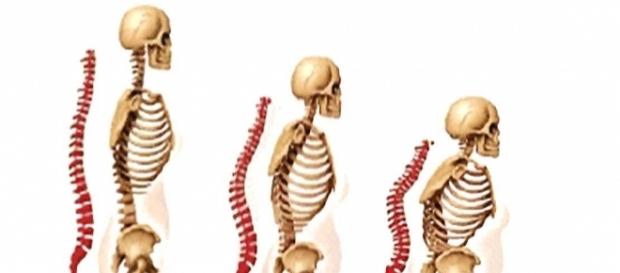 Osteoporose? Was Sie wissen sollten. - osd-ev.org Osteoporose? Was Sie wissen sollten. - osd-ev.org