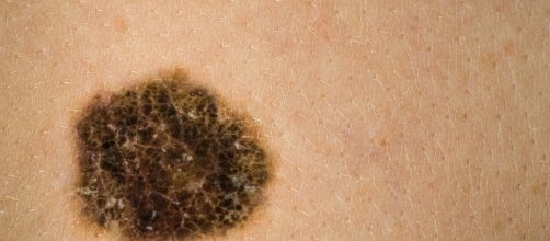 Il melanoma è il terzo tumore più diffuso sotto i 50 anni