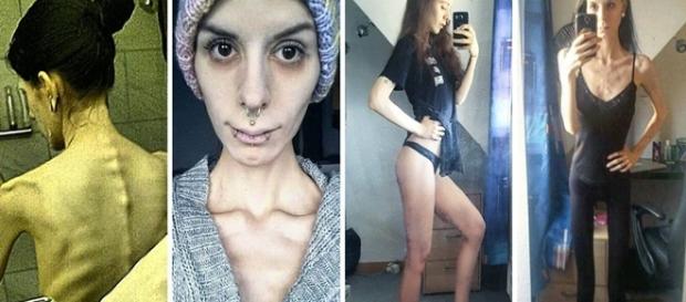 Jovem quase perdeu sua vida para a anorexia Jovem quase perdeu sua vida para a anorexia