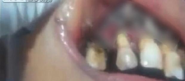 Mulher com larvas na boca (Foto: Captura de vídeo) Mulher com larvas na boca (Foto: Captura de vídeo)