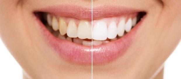Descubra o que é bom para clarear os dentes e o que é prejudicial Descubra o que é bom para clarear os dentes e o que é prejudicial